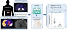 Improved Localization of Insulinomas Using <sup>68</sup>Ga-NODAGA-Exendin-4 PET/CT