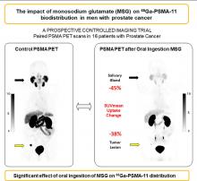 The Impact of Monosodium Glutamate on <sup>68</sup>Ga-PSMA-11 Biodistribution in Men with Prostate Cancer: A Prospective Randomized, Controlled Imaging Study