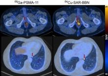 Utility of <sup>64</sup>Cu-Sarcophagine-Bombesin PET/CT in Men with Biochemically Recurrent Prostate Cancer and Negative or Equivocal Findings on <sup>68</sup>Ga-PSMA-11 PET/CT