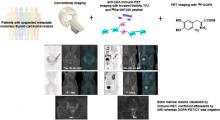 Anti-CEA Pretargeted Immuno-PET Shows Higher Sensitivity Than DOPA PET/CT in Detecting Relapsing Metastatic Medullary Thyroid Carcinoma: Post Hoc Analysis of the iPET-MTC Study