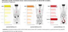 Interobserver Agreement on Automated Metabolic Tumor Volume Measurements of Deauville Score 4 and 5 Lesions at Interim <sup>18</sup>F-FDG PET in Diffuse Large B-Cell Lymphoma