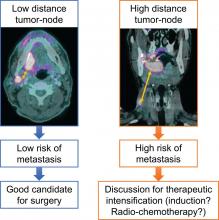 <sup>18</sup>F-FDG PET/CT–Based Prognostic Survival Model After Surgery for Head and Neck Cancer