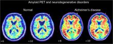 The Role of Amyloid PET in Imaging Neurodegenerative Disorders: A Review