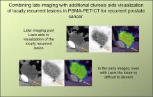 Combination of Forced Diuresis with Additional Late Imaging in <sup>68</sup>Ga-PSMA-11 PET/CT: Effects on Lesion Visibility and Radiotracer Uptake