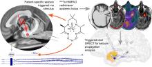 Triggered Seizures for Ictal SPECT Imaging: A Case Series and Feasibility Study