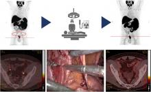 Prostate-Specific Membrane Antigen–Targeted Radioguided Pelvic Lymph Node Dissection in Newly Diagnosed Prostate Cancer Patients with a Suspicion of Locoregional Lymph Node Metastases: The DETECT Trial