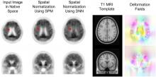 Fast and Accurate Amyloid Brain PET Quantification Without MRI Using Deep Neural Networks