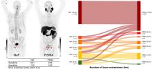 Prospective Head-to-Head Comparison of <sup>18</sup>F-PSMA PET/CT and <sup>18</sup>F-NaF PET/CT for Assessing Bone Metastases in 160 Patients with Newly Diagnosed High-Risk Prostate Cancer